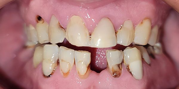 Close-up of severely decayed, crowded teeth with brown discoloration and gaps