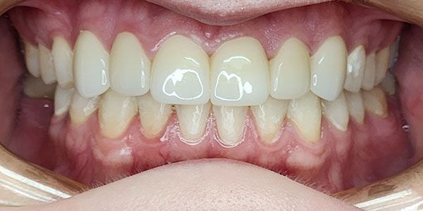 Close-up of a smiling mouth showing white teeth and pink gums