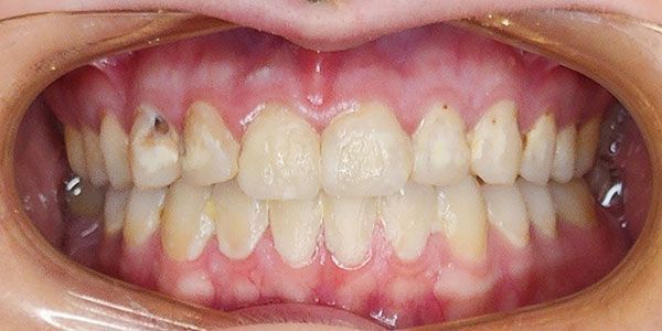 Close-up of teeth and gums showing dental crowding and yellow discoloration