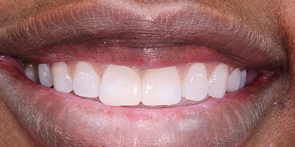 Close-up of a smiling mouth with white teeth and glossy pink lips