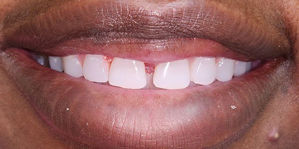 Close-up of a smiling mouth with glossy lips and white teeth