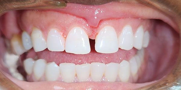 Close-up of a smiling mouth showing white teeth with slight gum redness and a missing lower front tooth