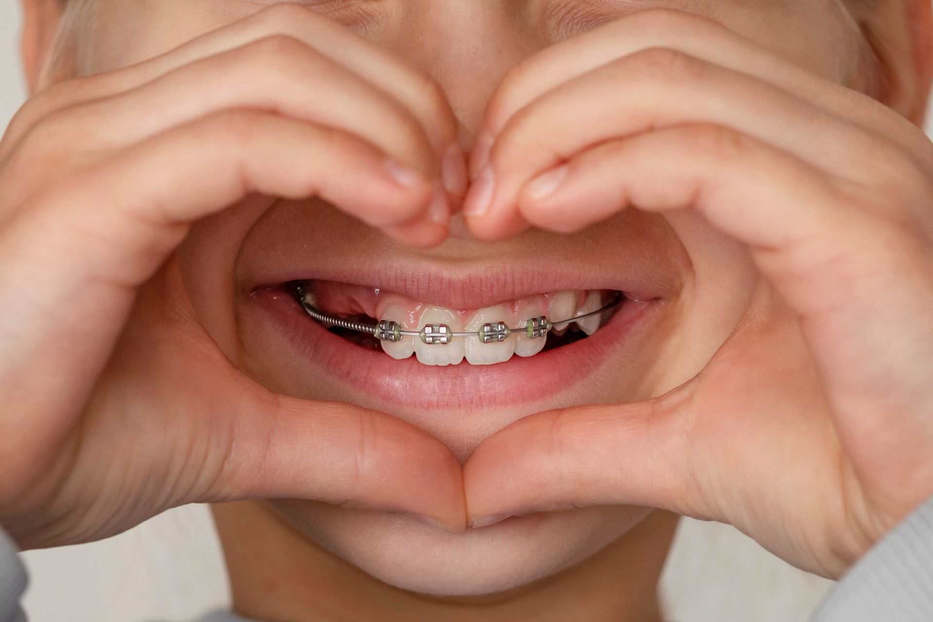 Child's teeth with braces for orthodontic alignment Child's teeth with braces for orthodontic alignment
