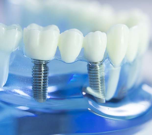 Smiling mouth with a dental implant callout showing a tooth and metal screw.