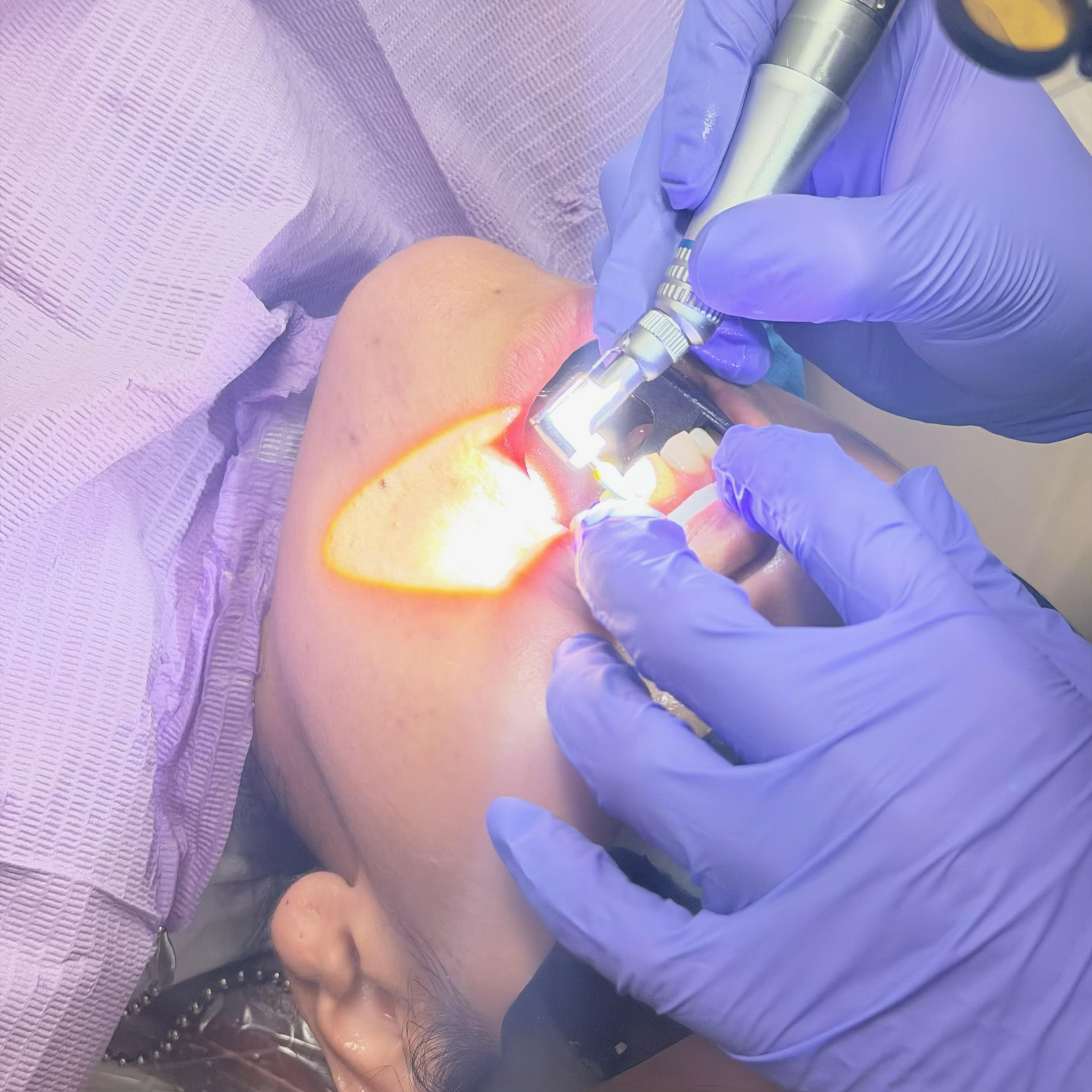 Dental procedure with gloved hands using a bright curing light inside a patient's open mouth