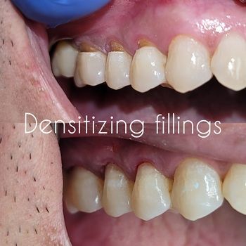 Before and after close-up of teeth showing densitizing fillings