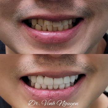 Before and after close-up of teeth, showing stained crowded teeth above and whiter aligned teeth below