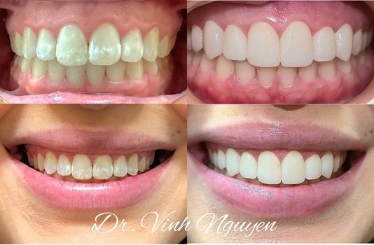 Four close-up smiles showing teeth before and after whitening treatment