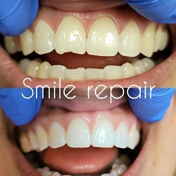 Before-and-after close-up of teeth smile repair, showing improved white front teeth with a lip retractor