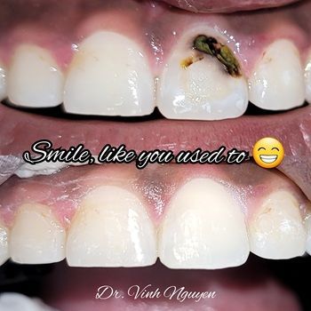 Before and after close-up of teeth, one with a dark cavity restored to a white smile.