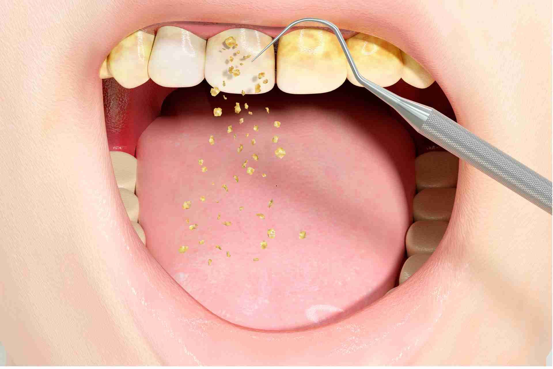 How to remove tartar from teeth without dentist