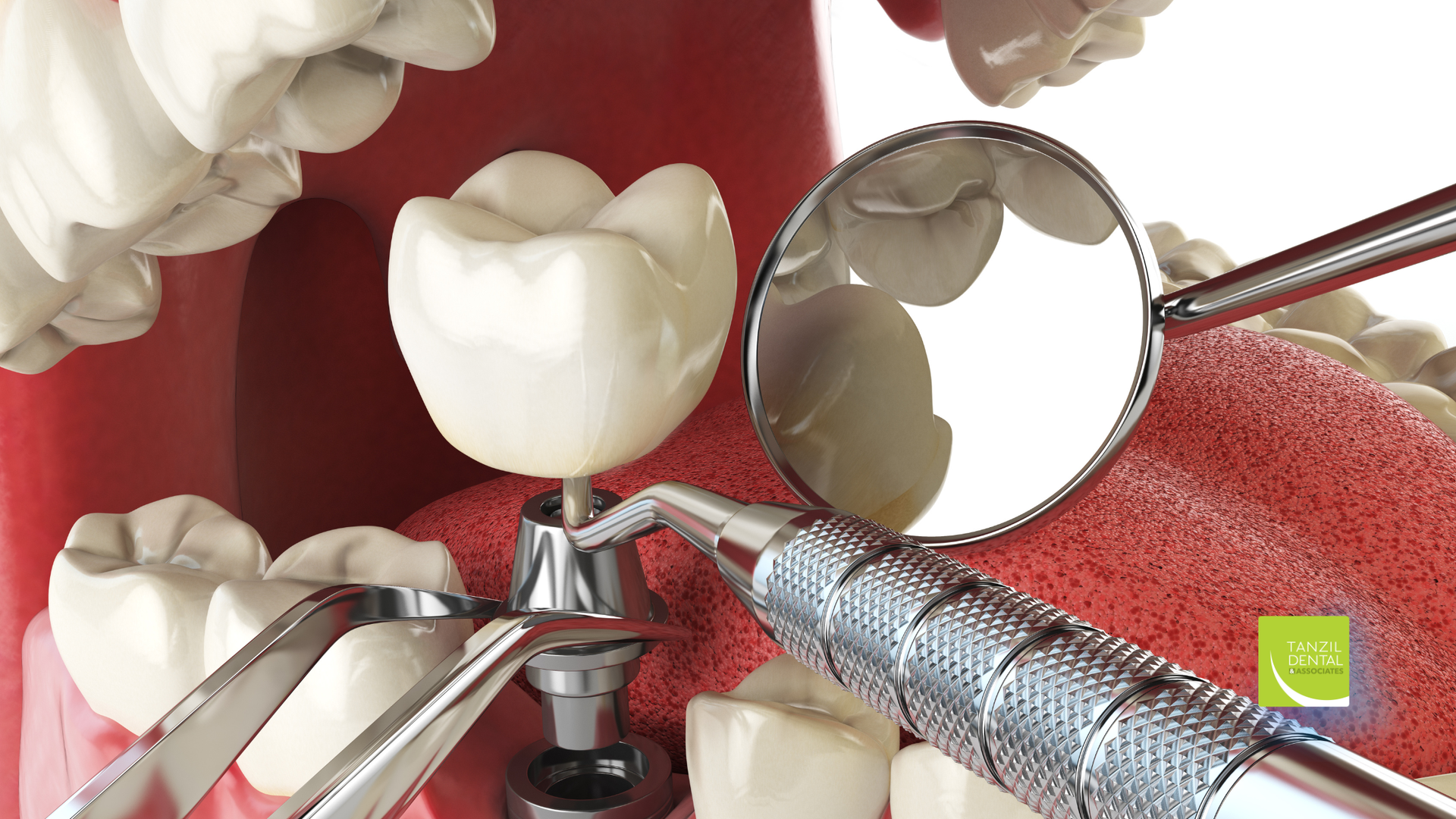 Dental tools examining a white crown implant in an open mouth.