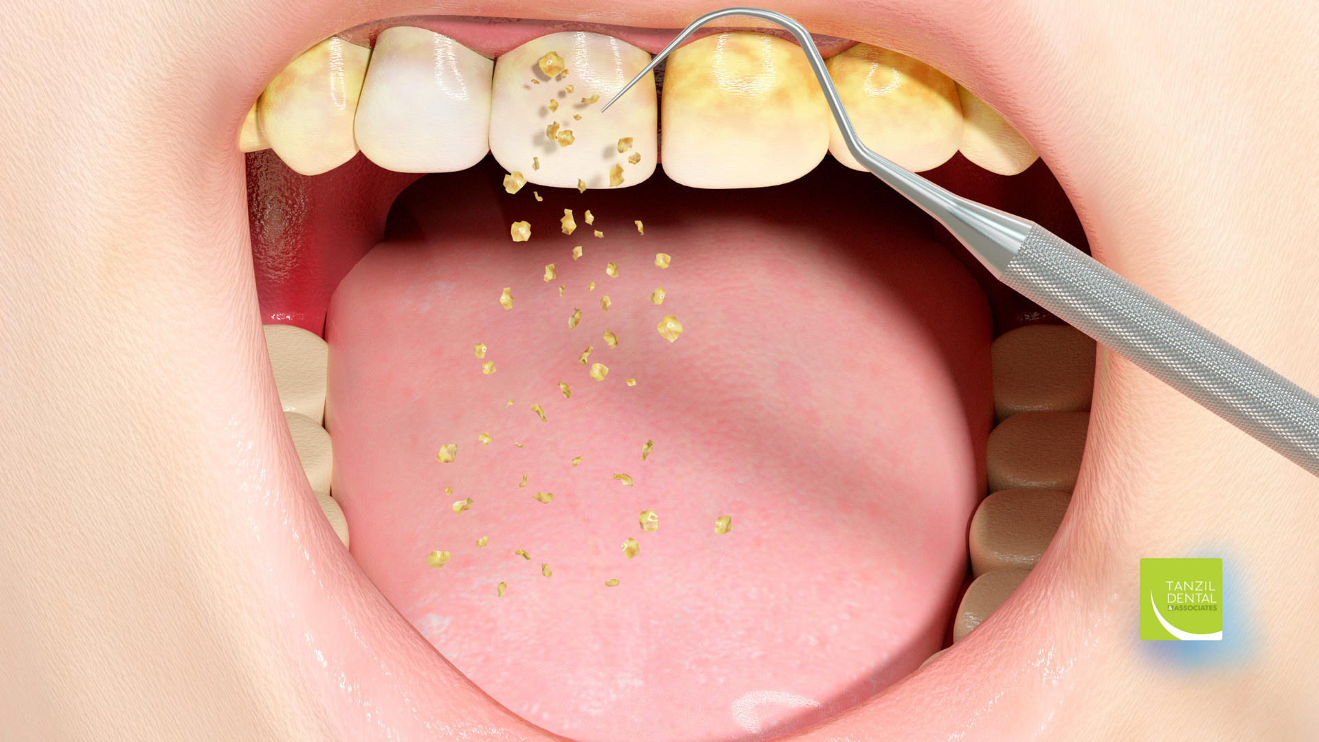 A person is getting their teeth examined by a dentist.