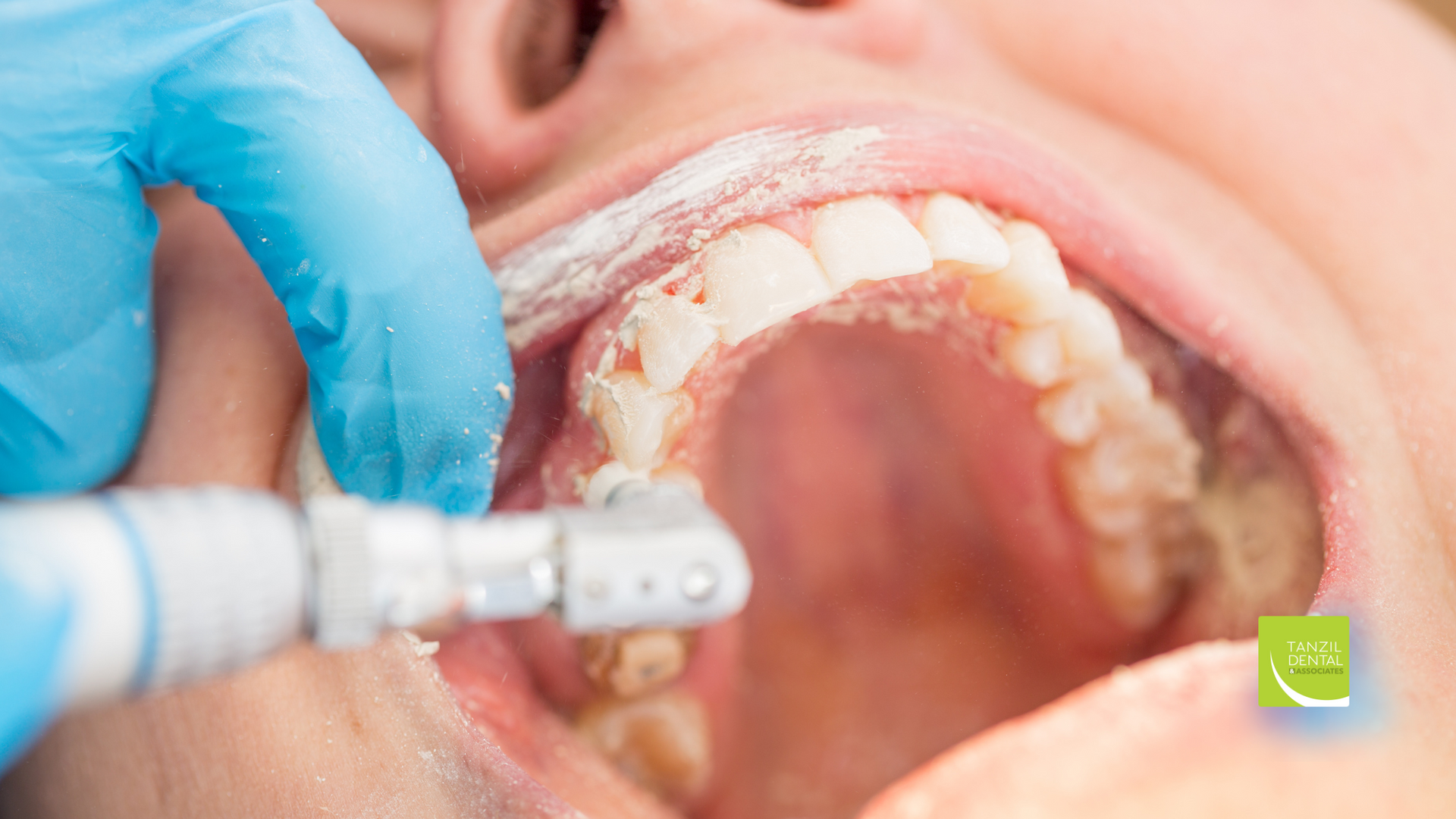A close up of a person getting their teeth cleaned by a dentist.