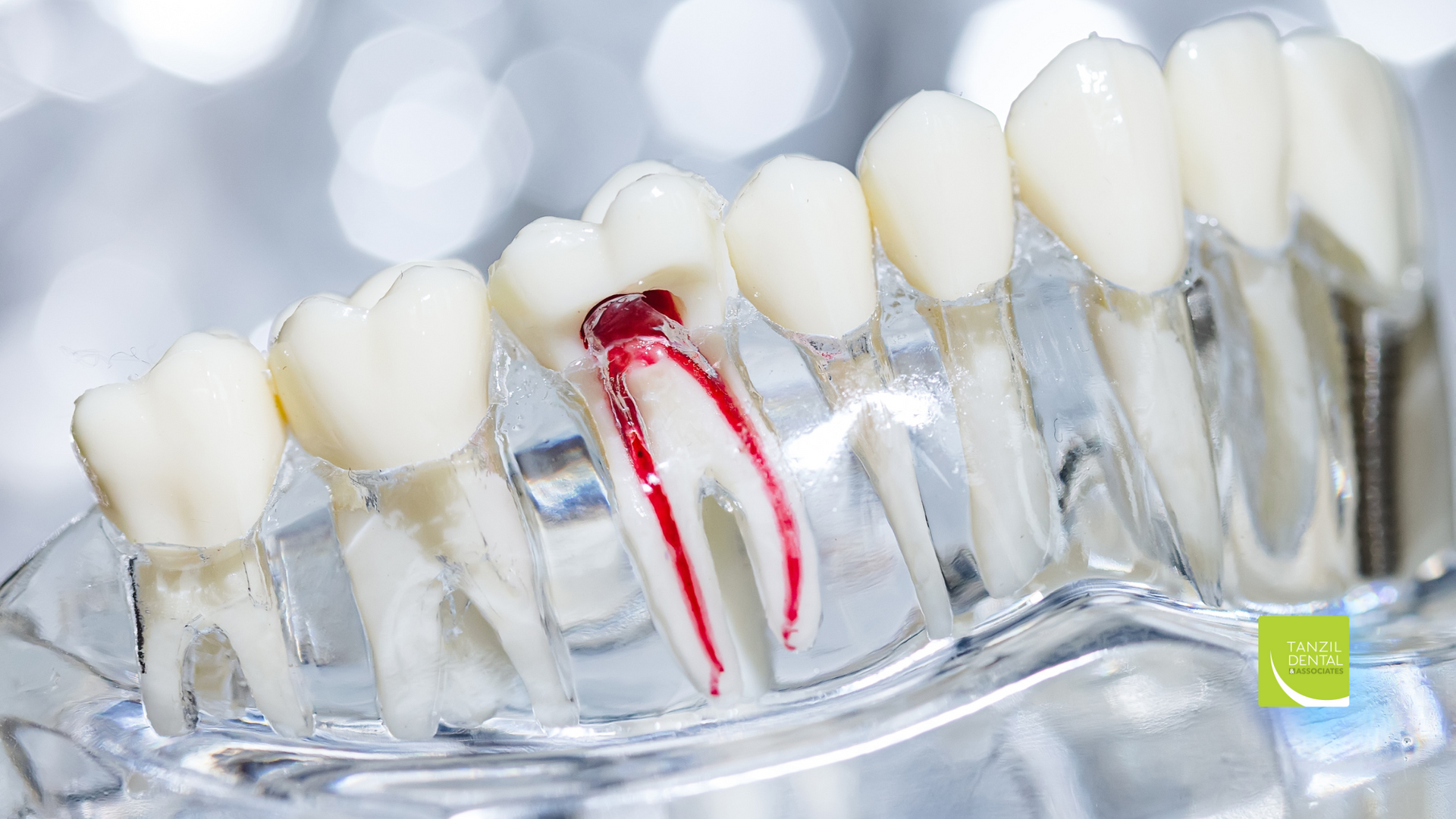 A close up of a model of teeth with a red root canal.