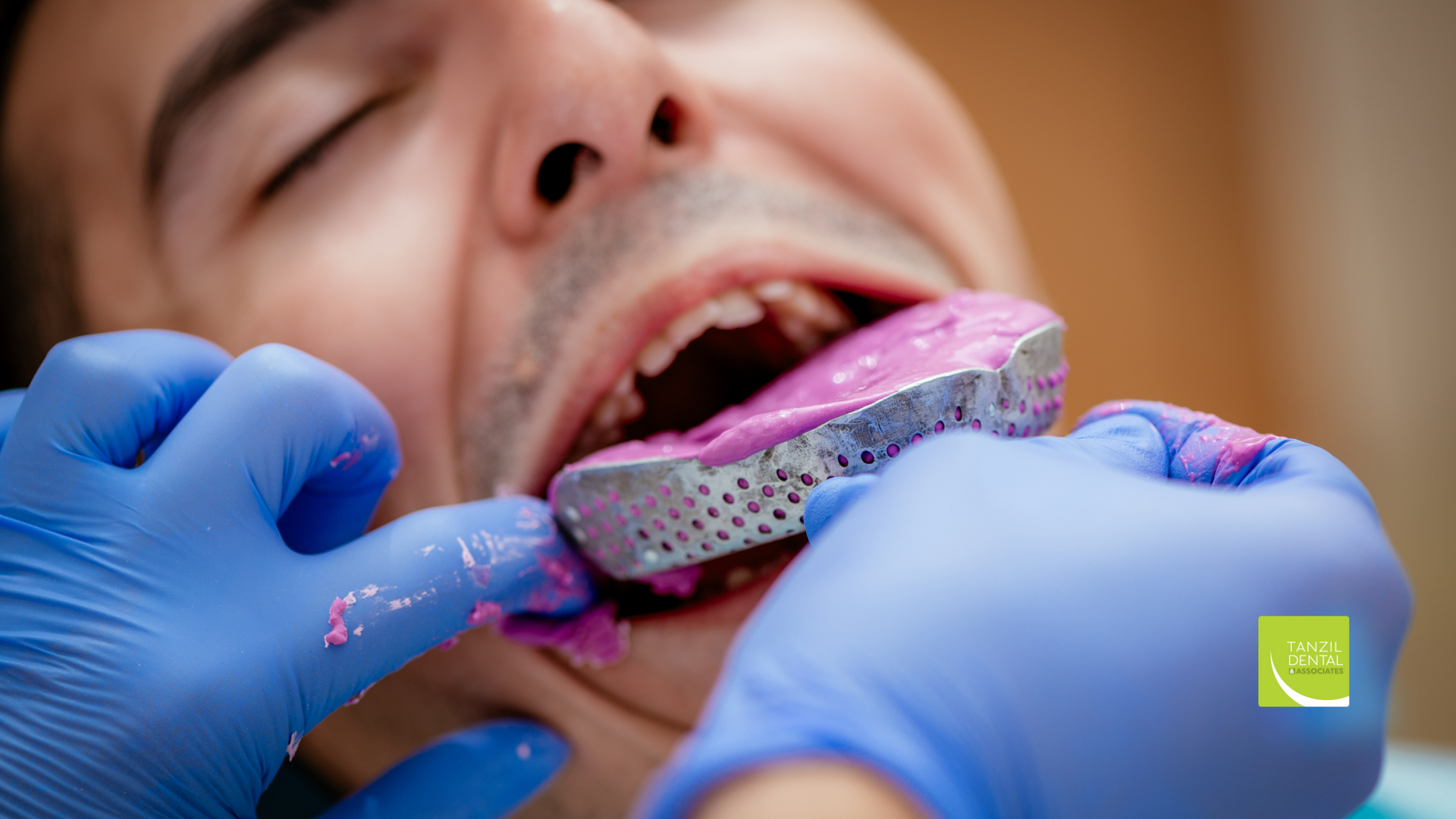 Dentist taking a mold of a patient's upper teeth using pink dental material.
