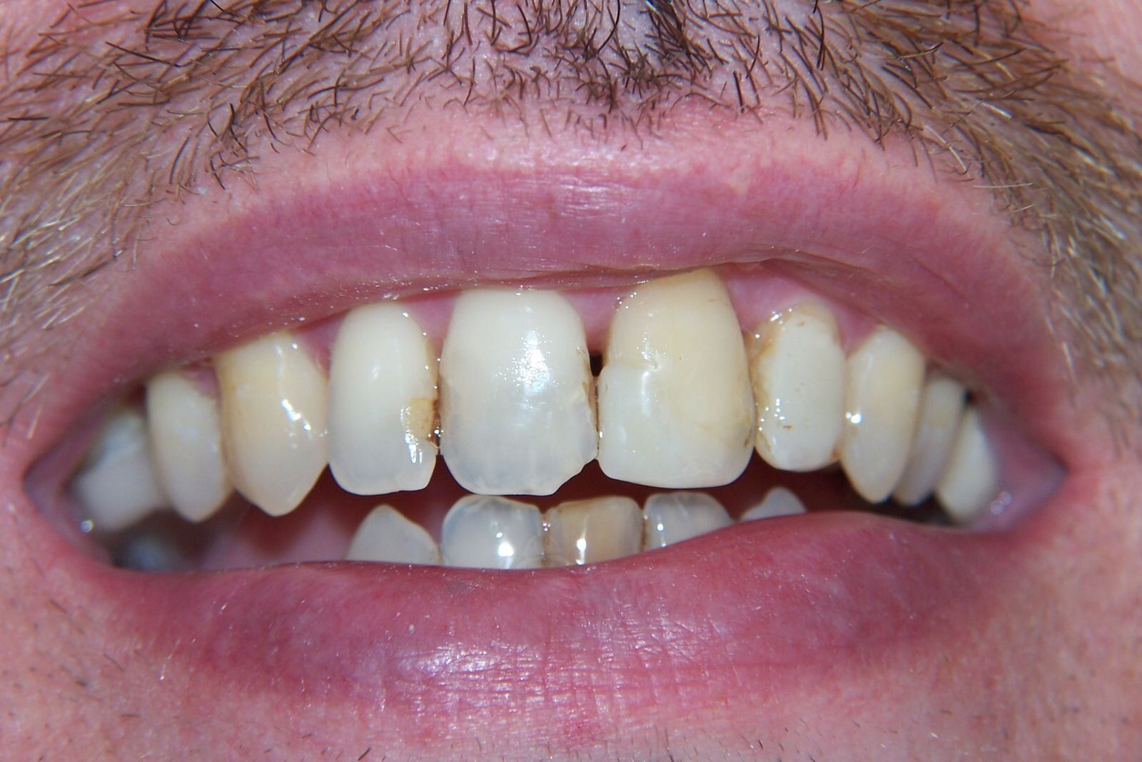 A close up of a man 's teeth with a beard.