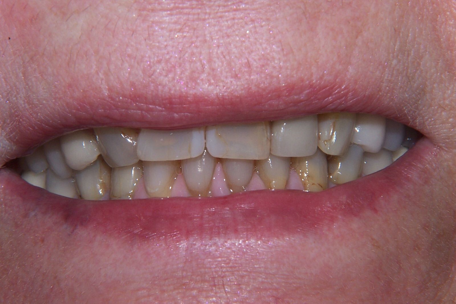 A close up of a person 's mouth with a lot of teeth.