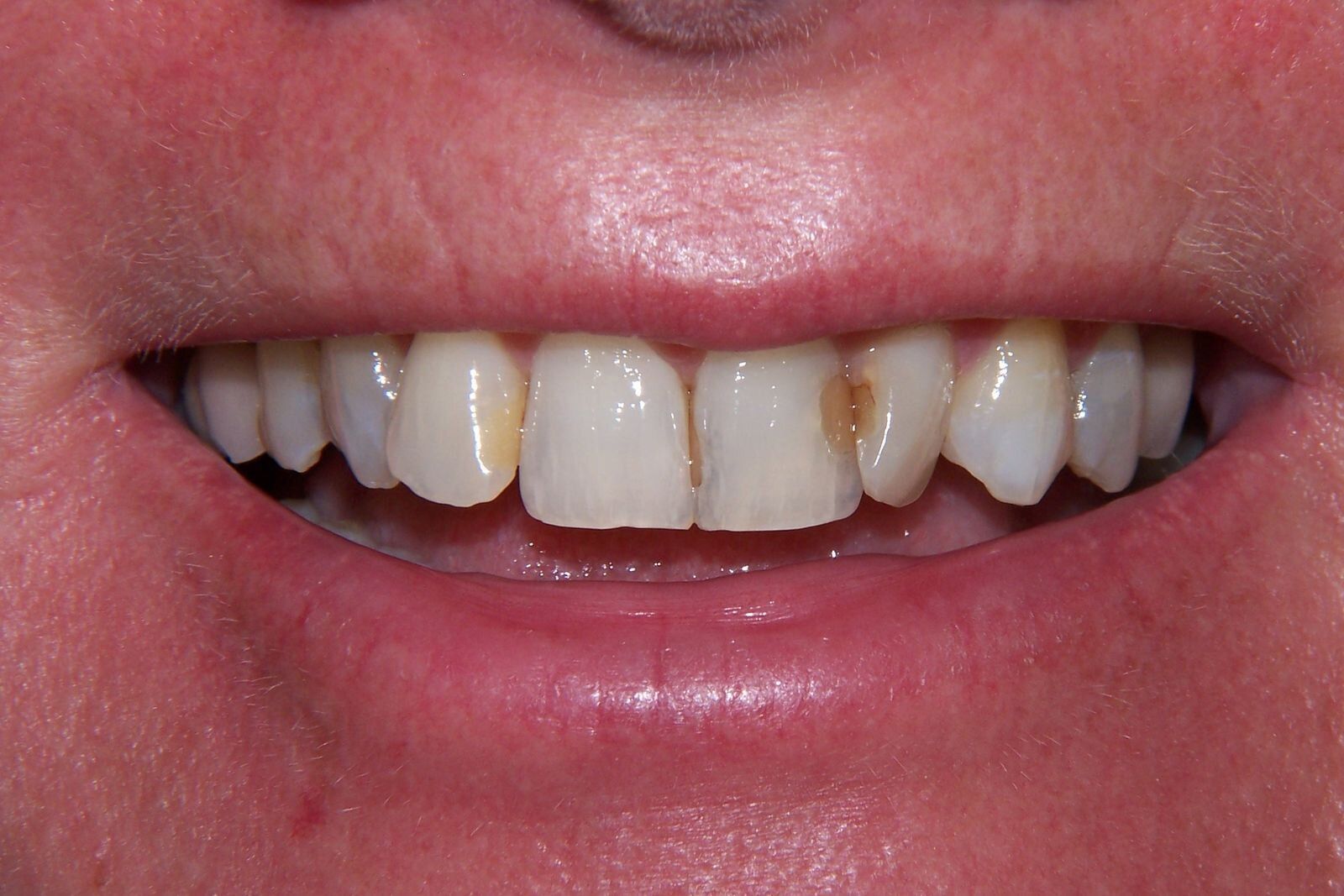 A close up of a person 's teeth with a missing tooth.