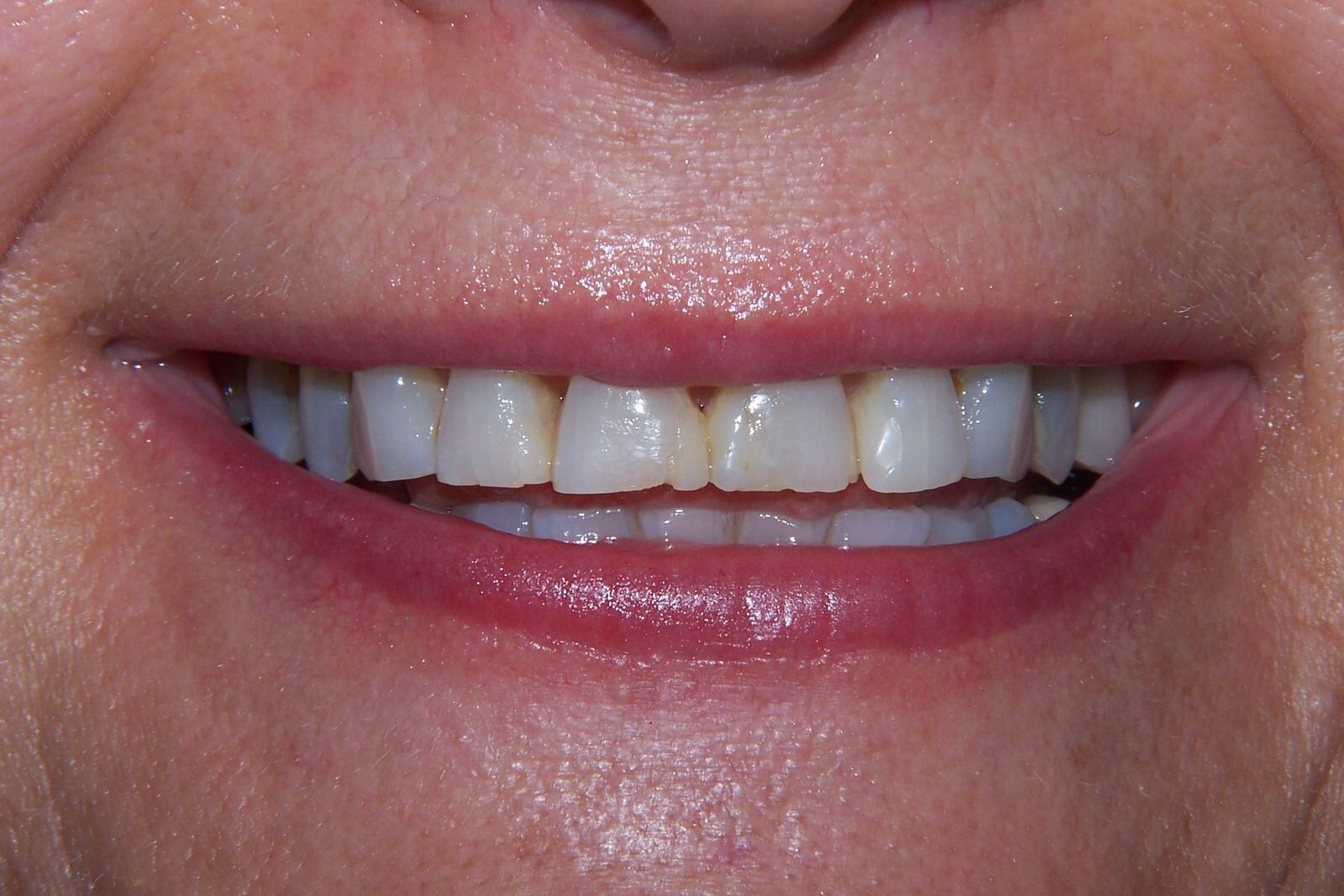 A close up of a woman 's smile with white teeth.