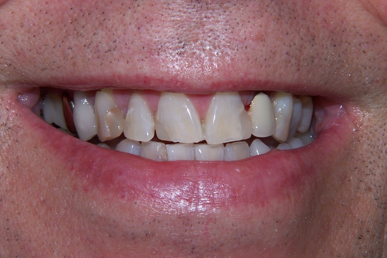 A close up of a man 's mouth showing his teeth