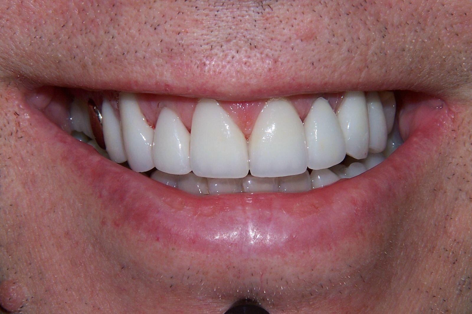 A close up of a man 's smile with white teeth.