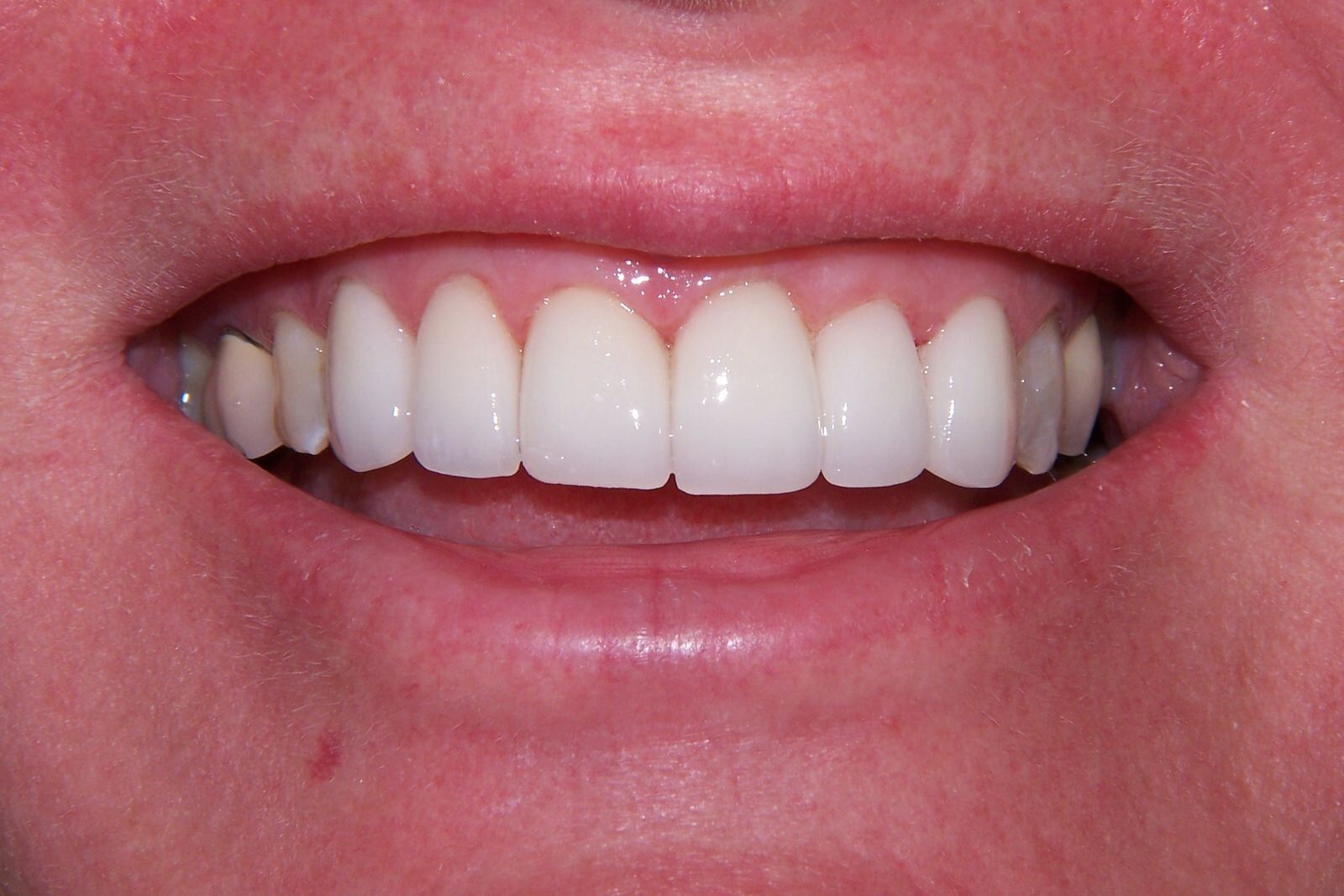 A close up of a person 's mouth with white teeth.