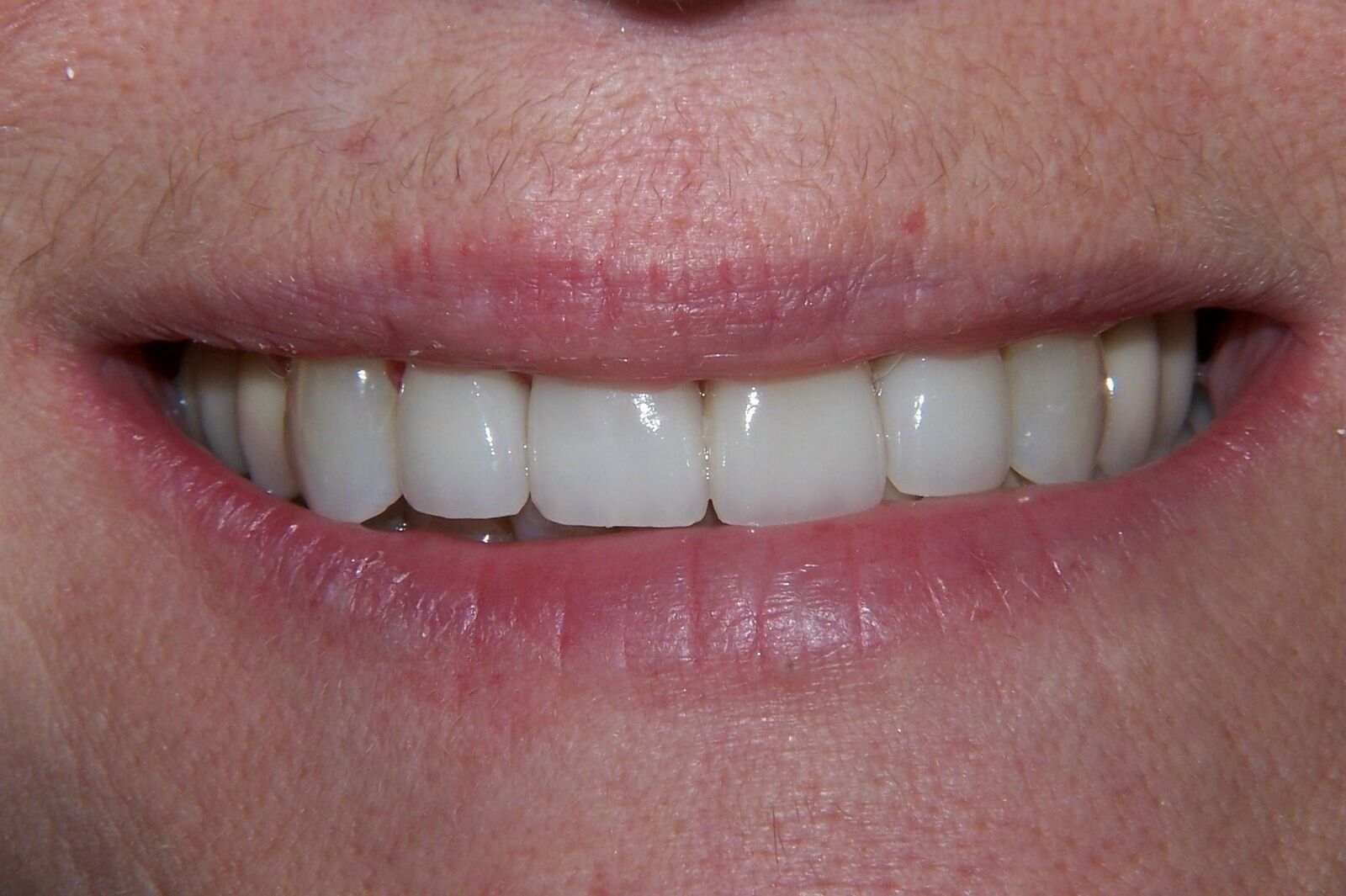A close up of a woman 's smile with white teeth.