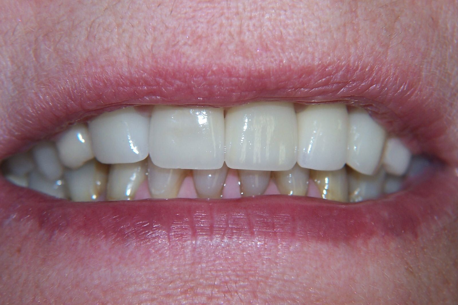 A close up of a woman 's mouth with white teeth.