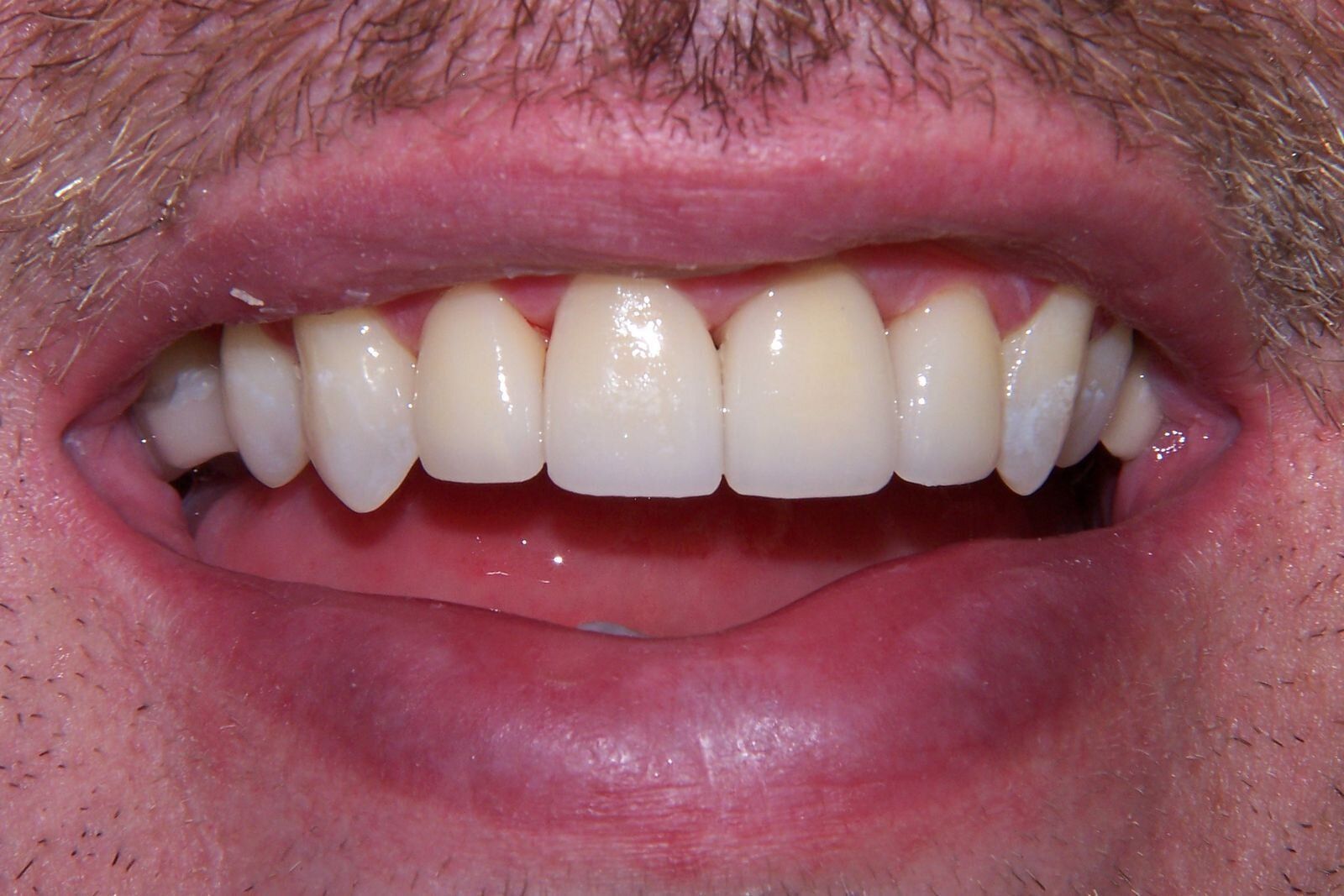 A close up of a man 's teeth with a beard.
