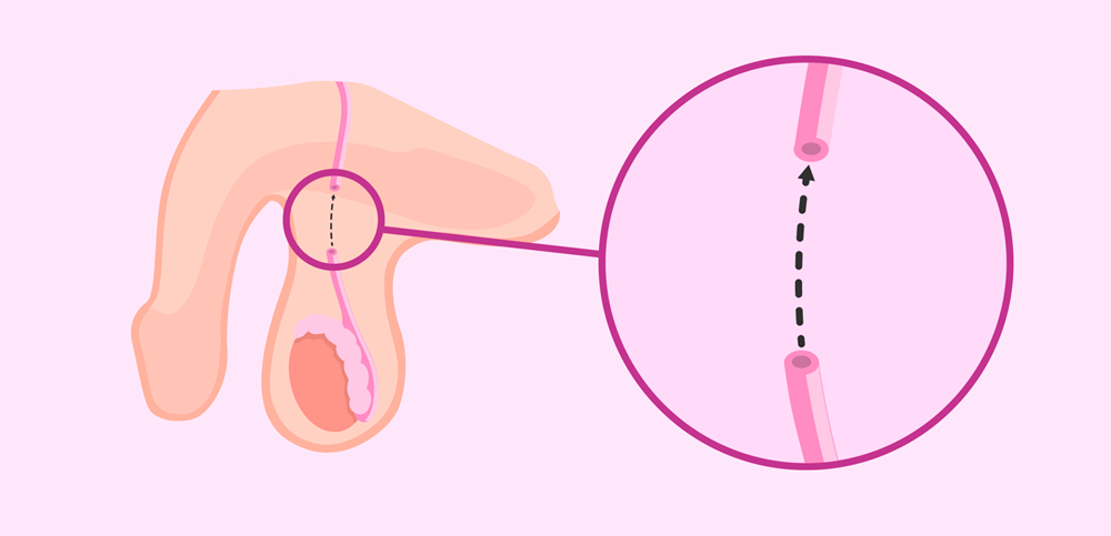 Como reverter a vasectomia: tudo o que você precisa saber