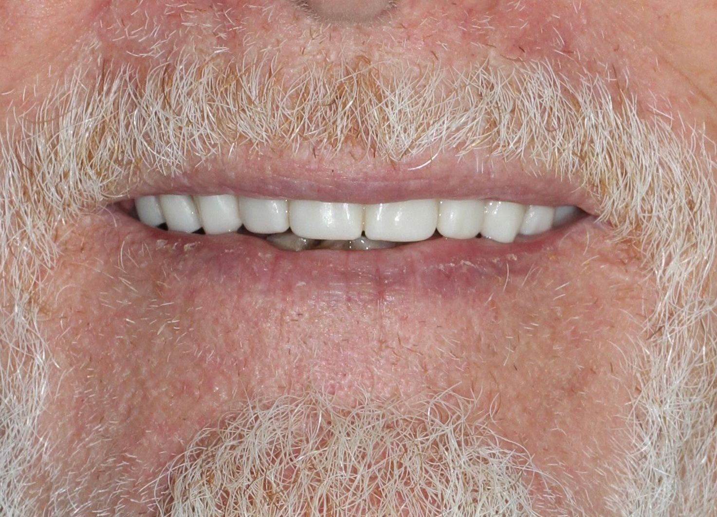 A close up of the results of Dr.Shaw's Complex restorative procedures, including a white straight smile.