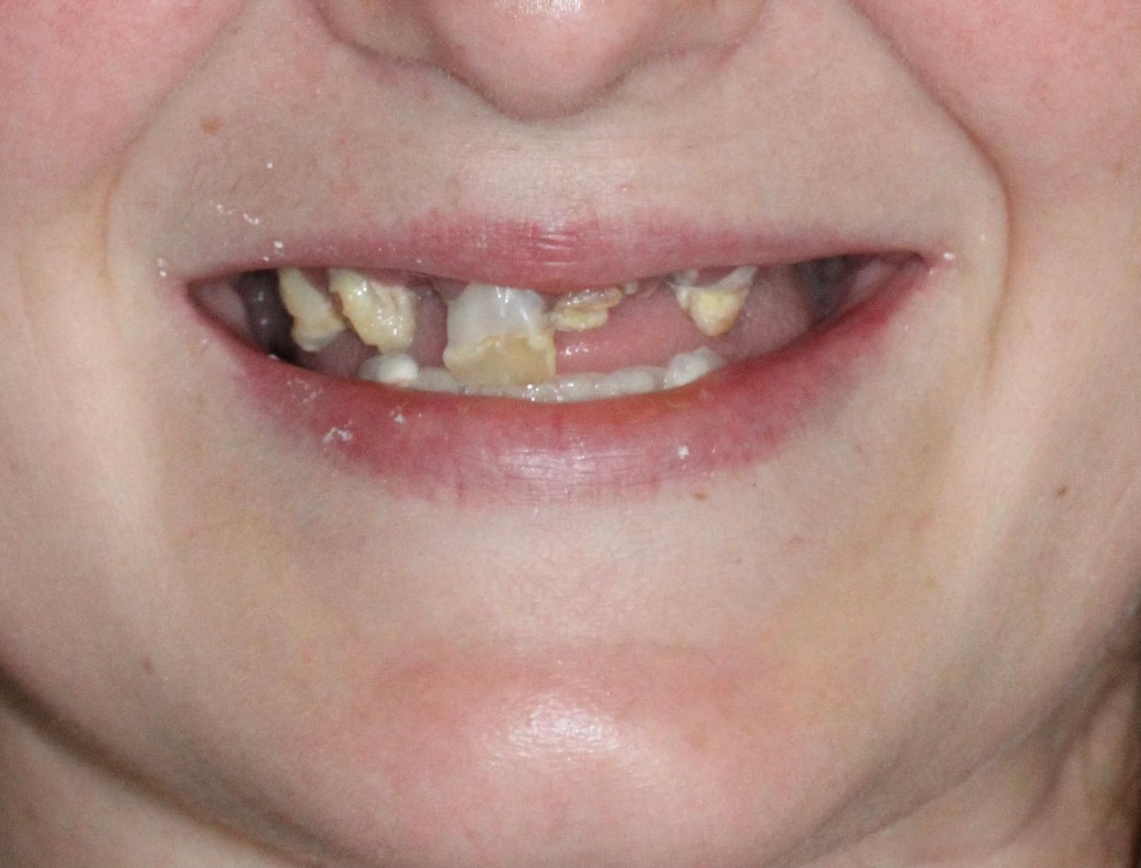 A close up of a womans teeth with damage prior to being treated by Dr.Shaw. 