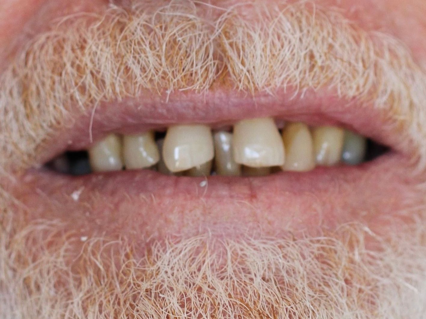 Before of a mans teeth prior to being treated by Dr.Shaw