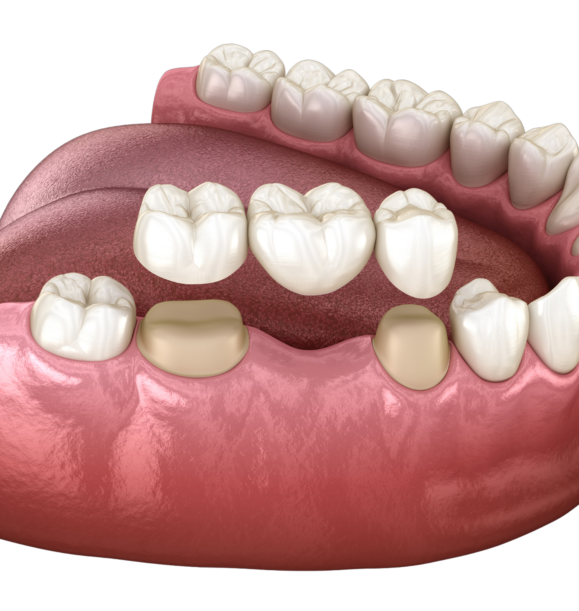 A 3d model of how a dental bridge is added