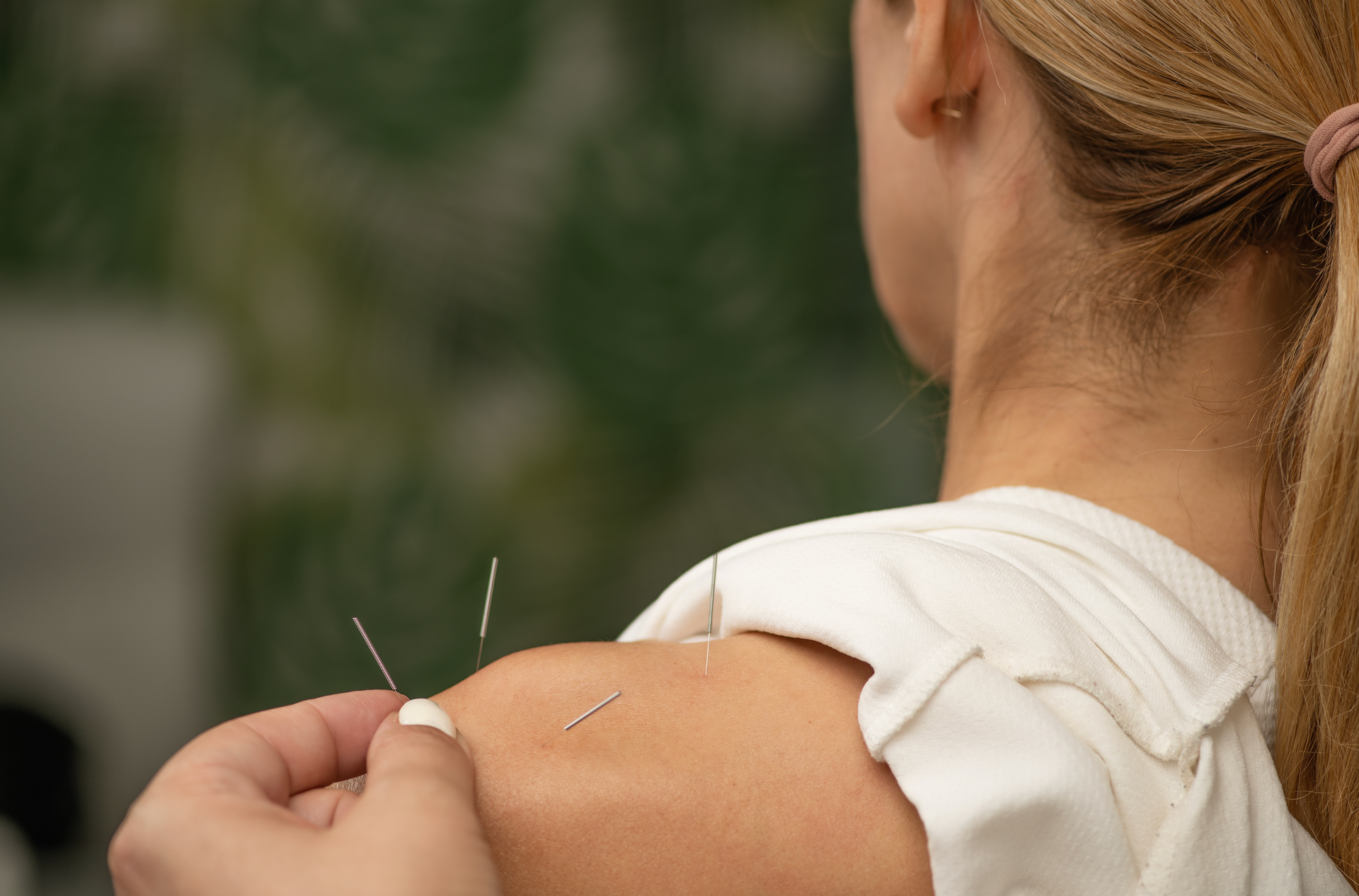 A woman is getting acupuncture on her shoulder.