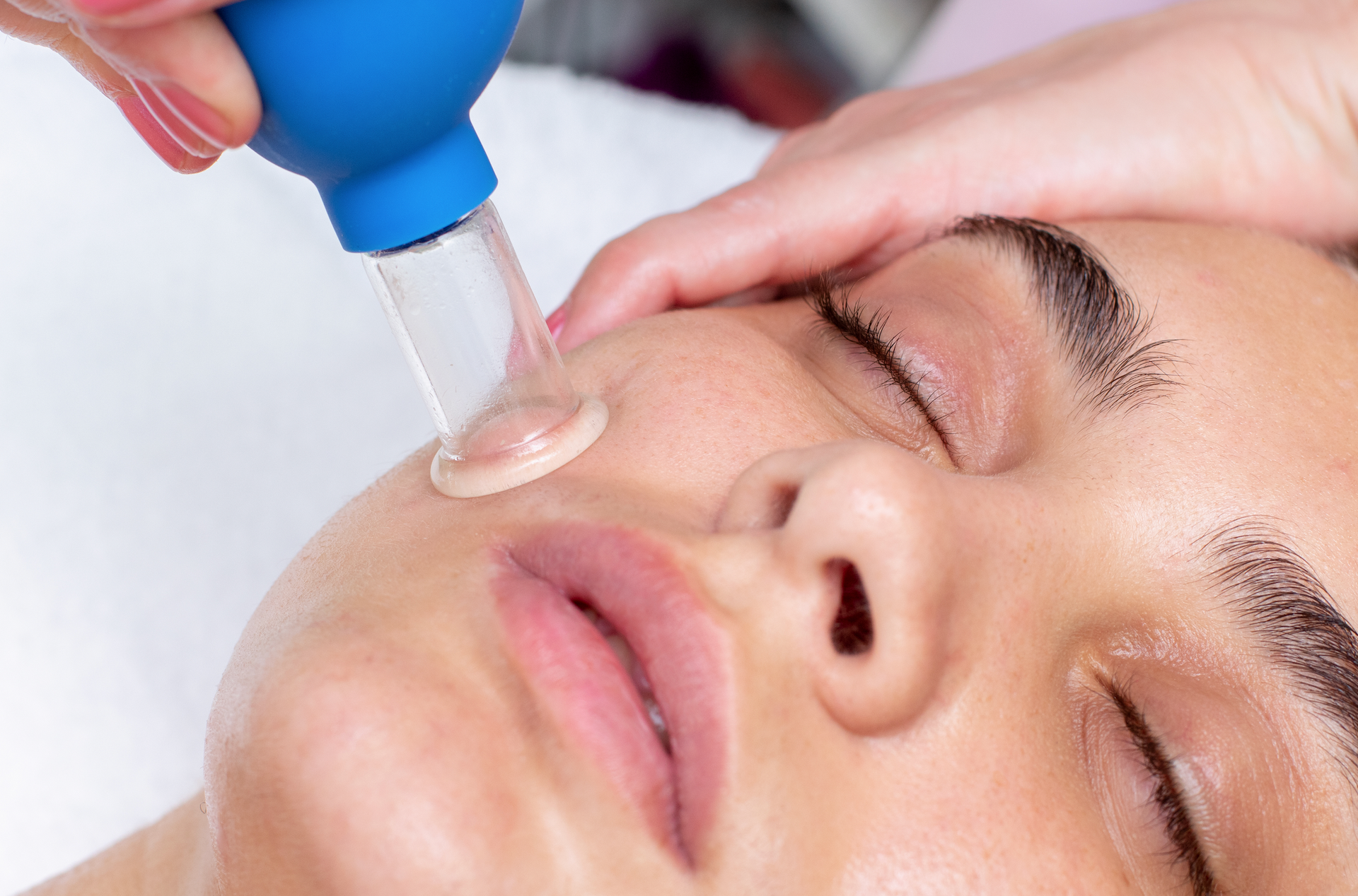 A woman is getting a cupping treatment on her face.