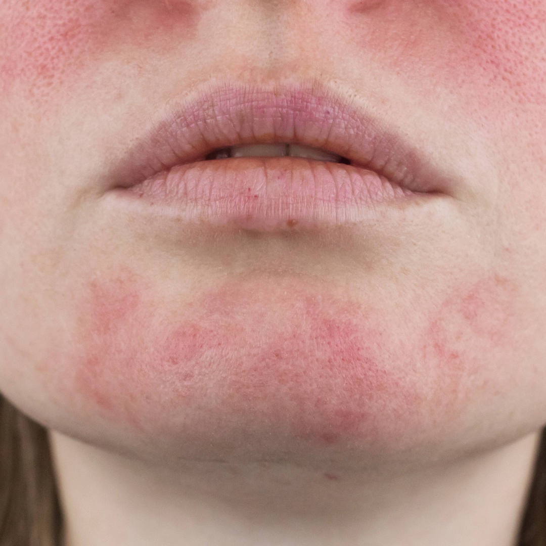 Rosacea treatments in Matawan, NJ