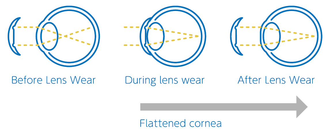 Diagram showing the eye before, during, and after lens wear, illustrating the flattening of the cornea.
