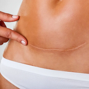 Hand touching a pale abdominal scar above a white waistband