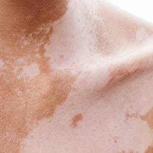 Close-up of light skin with irregular tan and white patches on the neck and shoulder.