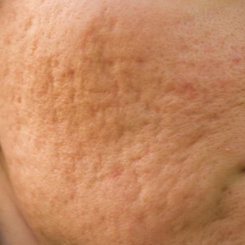Close-up of textured skin with visible dimpling and stretch marks