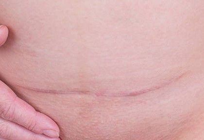 Close-up of a healed horizontal scar on pale skin with a hand gently touching nearby skin