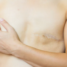 Close-up of a bare torso with a long surgical scar on the side of the chest