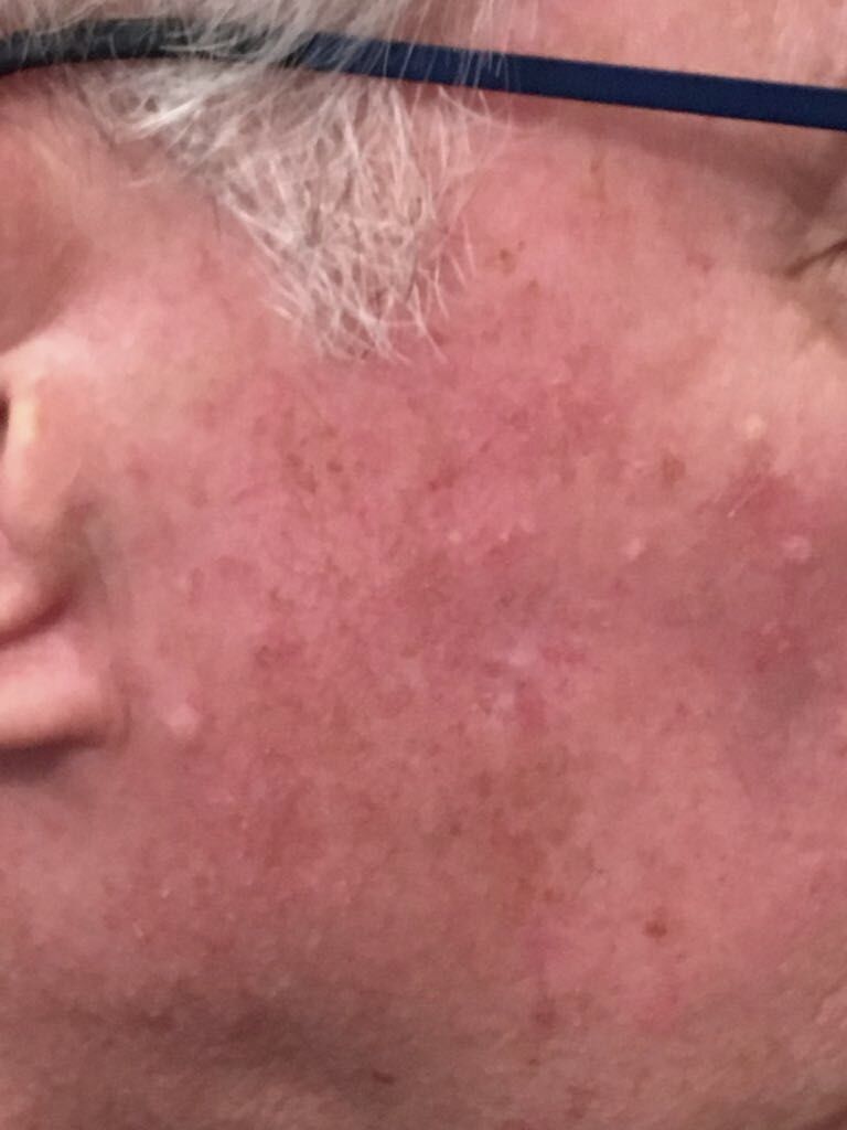cicatrice invisibile post trattamento con Contract Cicatrix