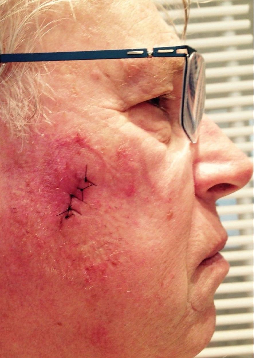 cicatrice visibile post operatoria