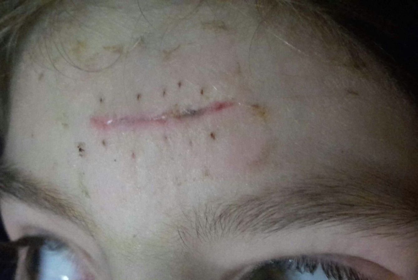 cicatrice visibile post trauma
