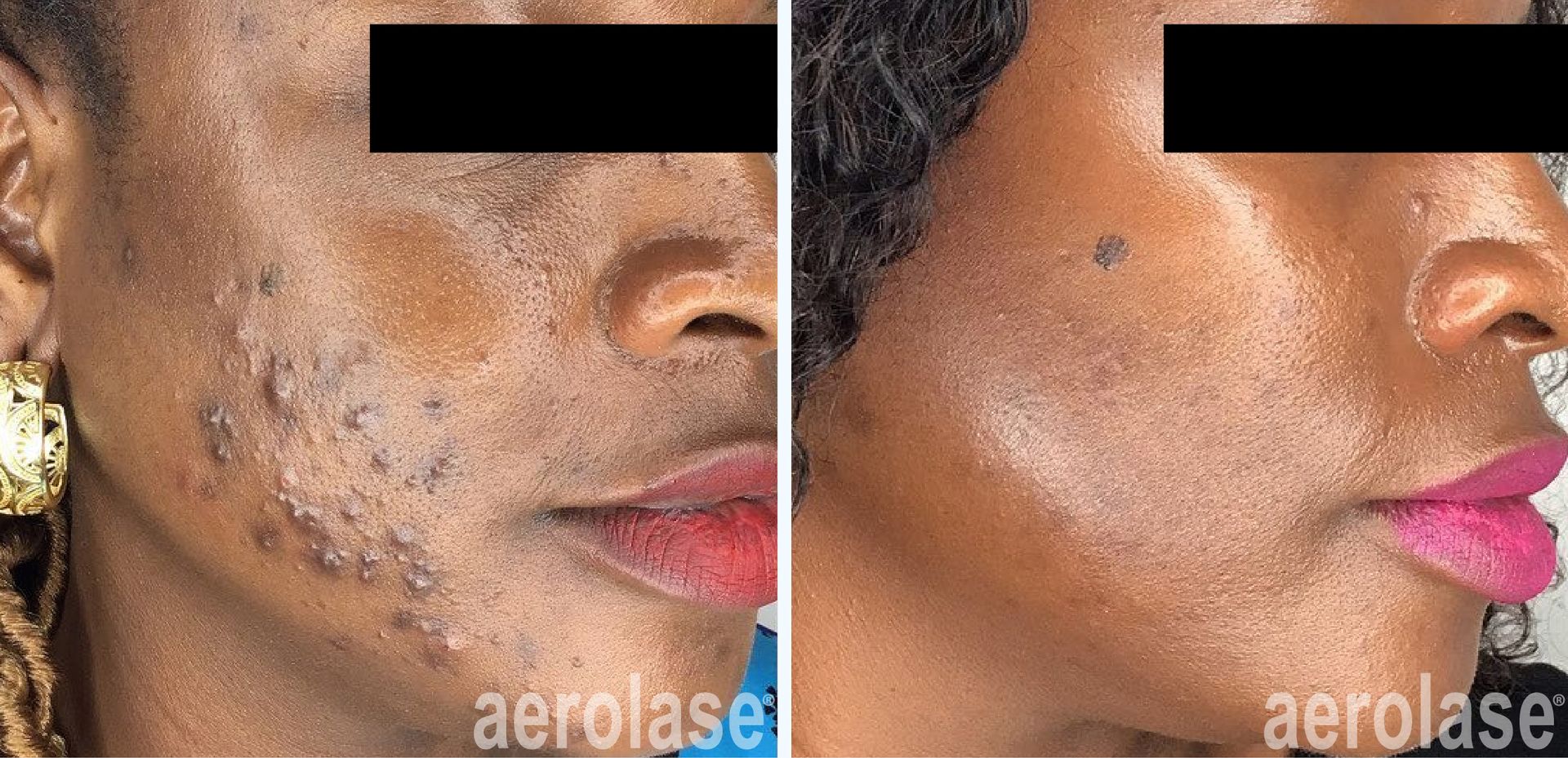 Side-by-side close-up of a cheek before and after acne treatment, showing clearer skin and brighter lip color