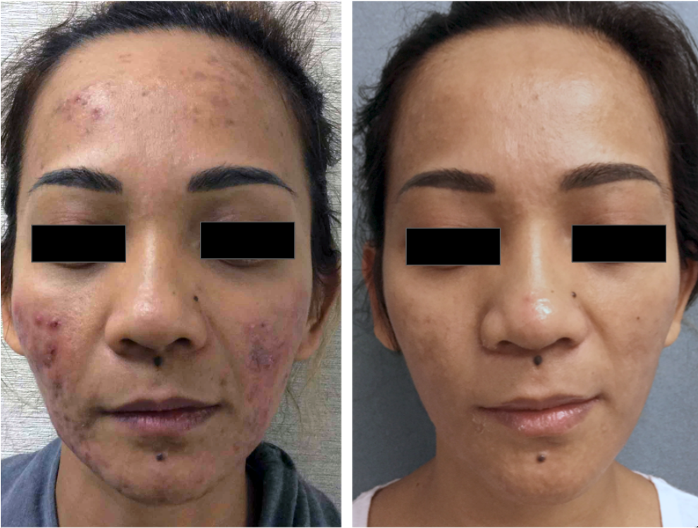 Before-and-after close-up of a face with acne on the left and clearer skin on the right.