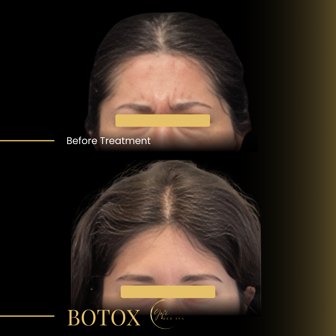 A woman 's face before and after botox treatment